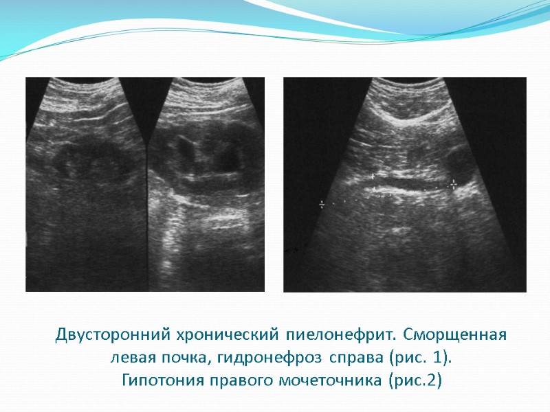 Двусторонний хронический пиелонефрит. Сморщенная левая почка, гидронефроз справа (рис. 1).  Гипотония правого мочеточника